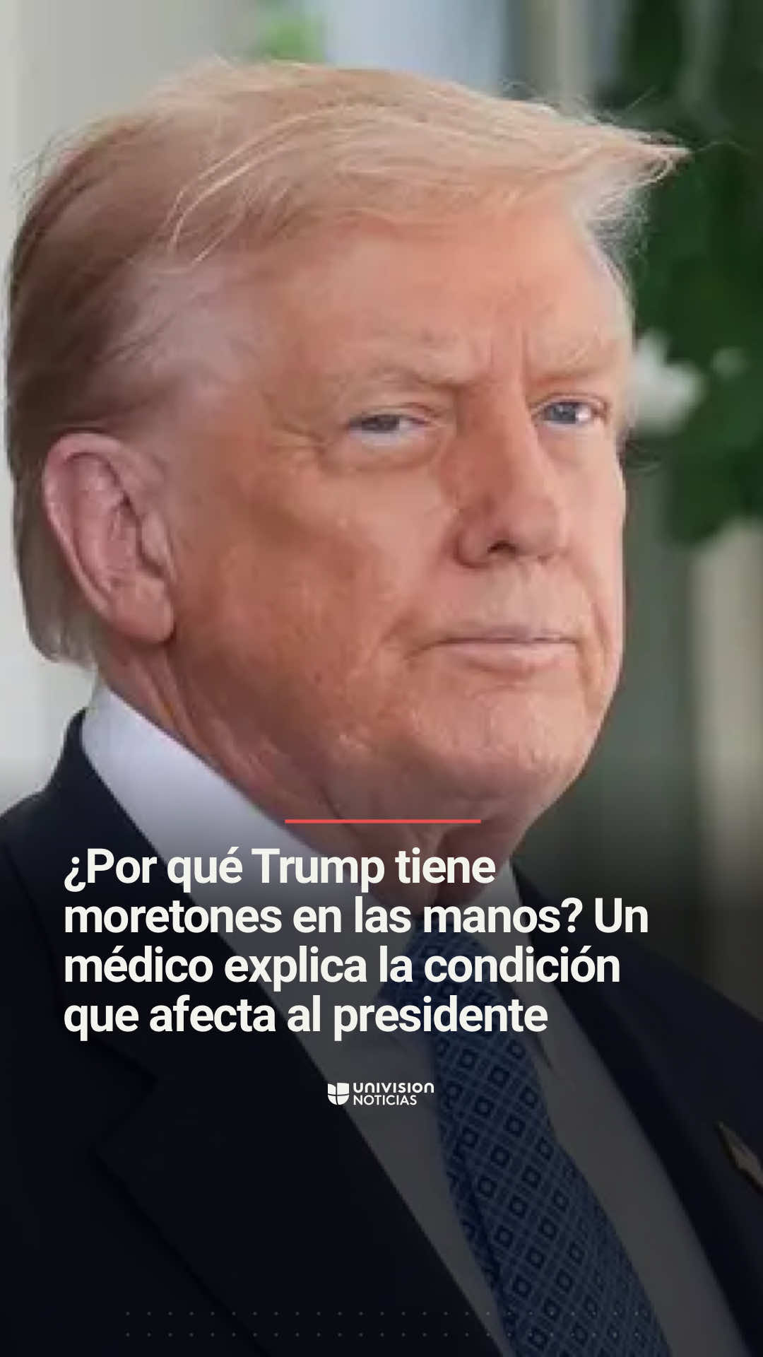 📌 ¿Por qué Trump tiene moretones en las manos? Un médico explica la condición que afecta al presidente. El presidente Donald Trump fue diagnosticado con una insuficiencia venosa crónica a mediados de agosto y, recientemente, durante una firma de documentos en la Casa Blanca, la mano derecha del mandatario se vio visiblemente inflamada y con moretones. El doctor Walter Sandoval, médico internista y geriatra, explica de qué se trata esta condición. 📺 Más del @Edición Digital a las 12pm/11C. #Trump #DonaldTrump #Presidente #insufiencienciavenosa 
