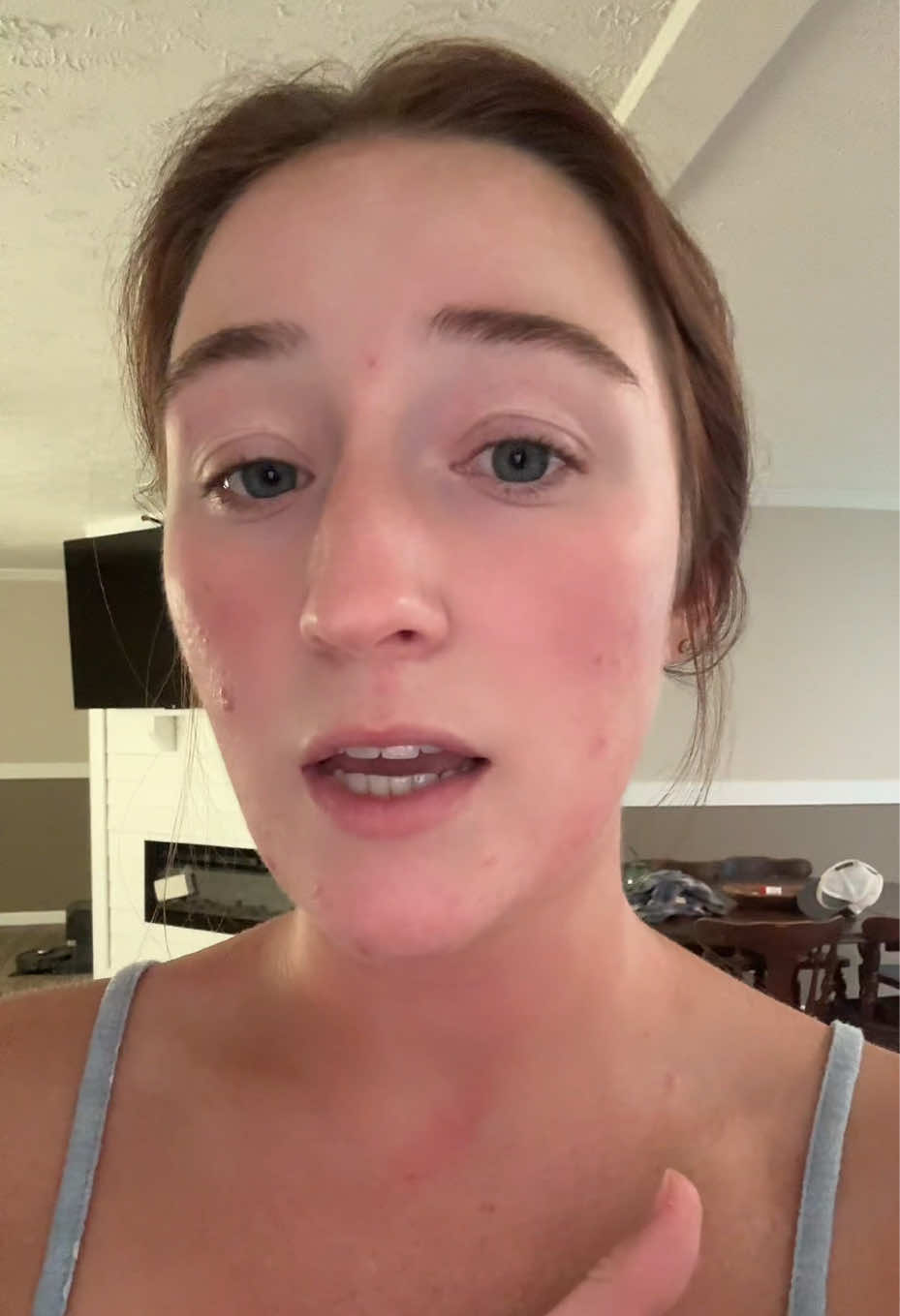 my acne journey will never end. 