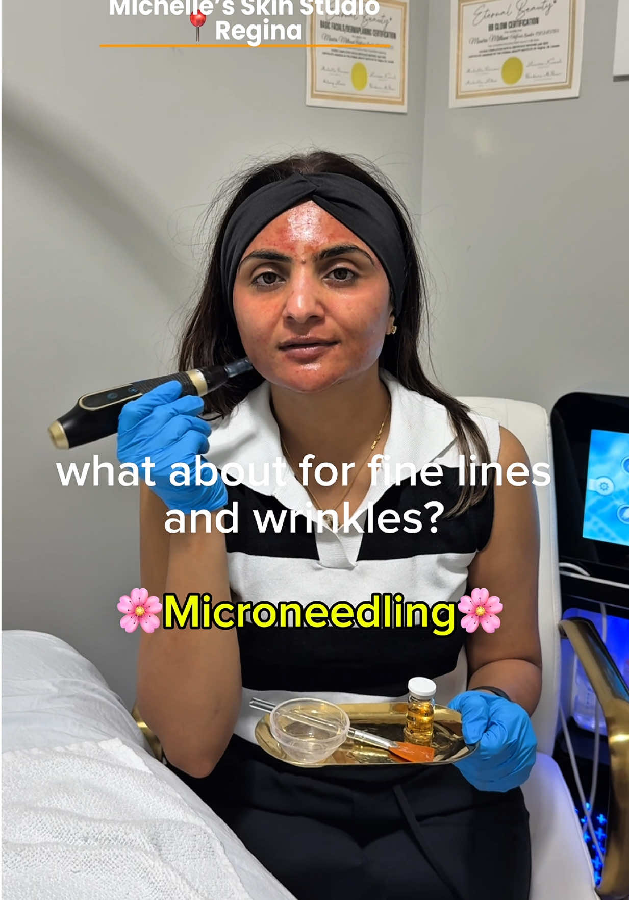 ✨ One treatment, countless benefits✨ Acne scars? Fine lines? Uneven skin tone? The answer is always 👉 Microneedling 💉💫 Your all-in-one solution for smoother, youthful, radiant skin 🌸 #fyp #fypシ #microneedling 