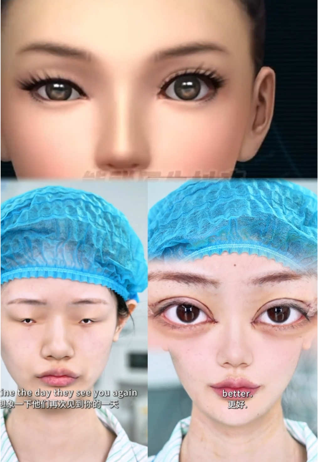 #雙眼皮 #双眼皮手术 #眼睛 