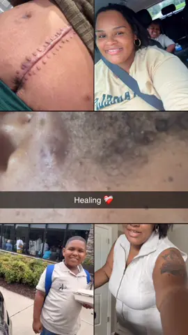 What a journey open incision gastric bypass 7.5 weeks post open #creatorsearchinsights 