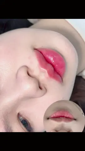 Filler không giúp bạn thành công, nhưng ít nhất giúp bạn cười đẹp hơn khi thành công