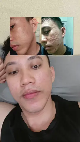 cakep benar gw 🤣🤣🤣  kulit cerahan Ama bopeng mendingan #pih #pie #scar #treatmentbopeng #bopeng 