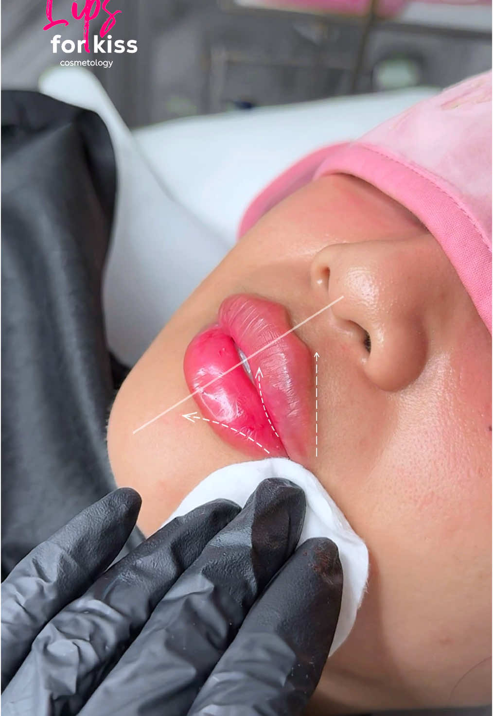 Russian lips technique 🌟 Just look at the lips 👄 Beautiful lips augmentation  📍Moscow | Dubai | London appointments Schedule an appointment with one of our talented aesthetic doctors 👉 Sign up now: www.LFK-academy.com #recommendations #cosmetology #skincare  #fyp #fashion #estetik #lipfiller #jawline #fullface #botox #lifting #beauty #iconicLips #aestheticlips #lipenhancement #увеличениегуб #увеличениегубмосква #fullface #fullfaceмосква #fullfaceuk #lipfillersessex #lipaugumentation #коррекцияскул #lipfilleruk #коррекцияугловмосква #коррекцияскулмосква #лицоподключ #lipsaugmentationlondon #cheeksaugmentationlondon #russianlipstechnique #russianlips #russianlipstraining #lipsforkiss