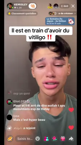 @KEMISLEY  #rediffusion #live #kemisley #vitiligo #viral 