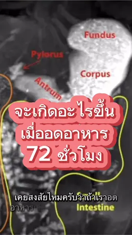 อดอาหาร 72 ขั่วโมง กินน้ำ กินเกลือแร่ #titokuni #เบาหวาน #ลดน้ําหนัก #ไขมัน #ความดัน 