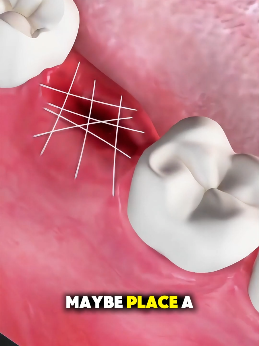 How Wisdom Tooth Extraction Is Done (3D Animation) #3dmedicalanimation  #medical3danimation  #toothextraction  #oralsurgery  #dentalsurgery 