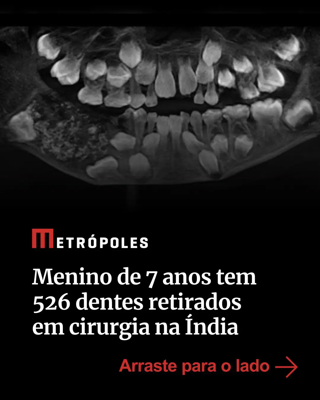 O que parecia apenas um inchaço no maxilar de um menino de 7 anos de Chennai, na #Índia, acabou revelando um dos casos mais raros já documentados #pela odontologia. Durante uma #cirurgia realizada em 2019, no Saveetha Dental College and Hospital, médicos encontraram 526 #dentes em miniatura dentro de uma massa localizada na mandíbula do garoto. #TikTokNotícias 📸 Saveetha Dental College and Hospitals/Divulgação