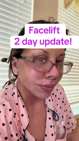 2 days post op. Doing better. I’ll update yall again soon #DrMcElwee #facelift #HoustonPlasticSurgery 