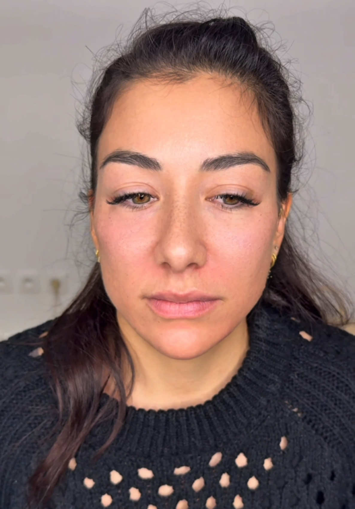 Non-surgical full face 