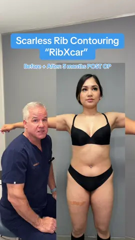 5 months post-op and the results speak for themselves—scarless rib contouring took her from a 32” waist to 27”! ✨ Incredible transformation, no visible scars, just stunning curves☺️ #plasticsurgery #ribcontouring #ribxcar #waistline #drsterry 