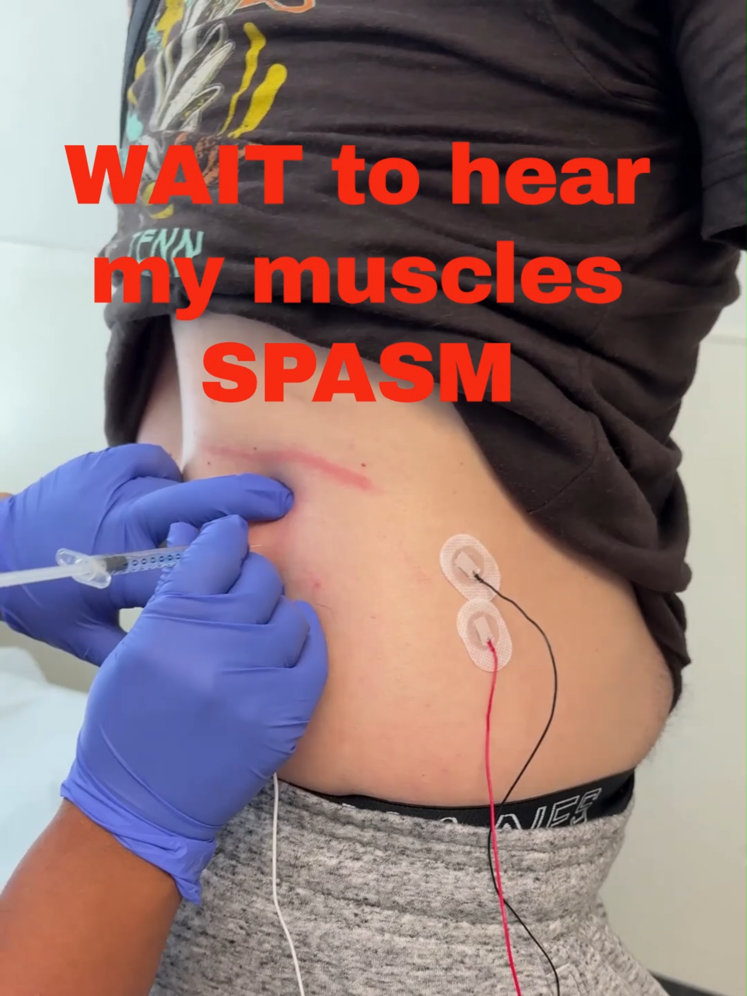 My back spasms aren’t caused by HSP directly—they’re from the way HSP changes my gait. Today’s treatments are about breaking that pain cycle so I can move with less guarding and more control. Every step has a story.” #HSP #HereditarySpasticParaplegia #FYP #BackSpasms #DisabilityAwareness #RayWalks4Real #EveryStepHasAStory#motivational #Inspirational