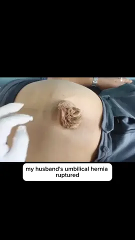 my husband's umbilical hernia burst and the worst happened #umbilicalhernia #hernia #husband #hospital 