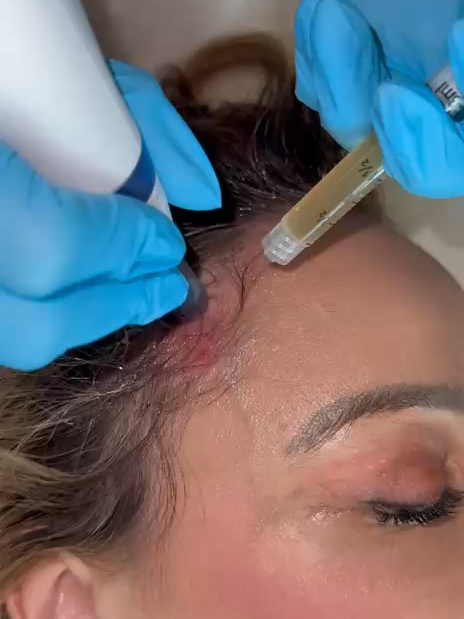 El microneedling en el cuero cabelludo, estimula el crecimiento del cabello y detiene su caída y fortalece los folículos capilares , un tratamiento mínimo invasivo, disponible en @ecologicamedspa #rosierivera #ecologicamedspa #microneedling