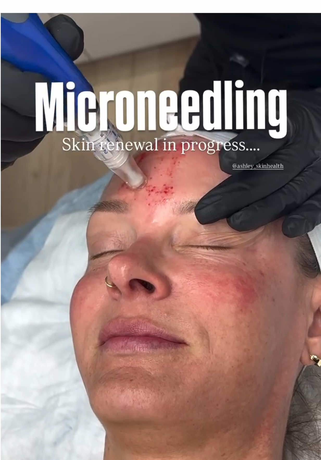 Microneedling isn’t just a trend — it’s science-backed skin renewal. ✨ What it does: ✔ Stimulates collagen + elastin ✔ Improves acne scars + fine lines ✔ Refines texture + tone  For a limited time, save $100 on a package of 3 SkinPen Microneedling Treatments Healthy, glowing skin is closer than you think. 📲 Want to find out if you’re a good candidate? Send us a DM! #Microneedling #SkinPen #SkinPenAmbassador