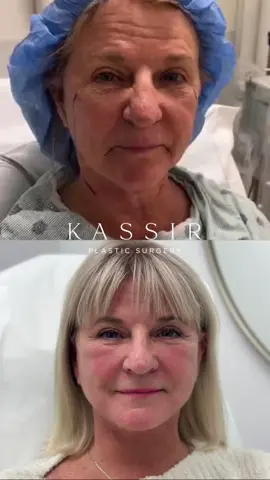 Here we have our beautiful 69 year old patient ONLY 1 month POST-OP who had a Revision Face & Neck Lift and CO2 Laser Resurfacing. She has minimal bruising and swelling.  Our patient wanted a total facial rejuvenation to bring back her confidence!  Our lovely patient disliked the loose, sagging skin she had and wanted a refreshed & rejuvenated look as she feels YOUNG on the inside and wants to match how she feels to how she looks on the outside. We performed a Revision Deep Plane Face & Neck Lift by releasing her retaining ligaments and repositioning her muscle (SMAS & platysma vertically). She has a much better chin-neck angle and the previously flat and droopy midface is full and lifted. These are the procedures our lovely patient had done: 1️⃣ Revision Face & Neck Lift 2️⃣ CO2 Fractional Laser A facial rejuvenating procedure specifically customized to fit and balance the patients facial features, expectations, cultural norms and ethnicity. Maintaining  their natural beauty without changing their identity! 🌟Notice that she looks RESTED and like a YOUNGER version of herself, NOT like a different person.  To schedule an appointment:  ☎️ 212-288-3000 📲 WhatsApp: 201-875-8482 💌 DM Locations: 📍65 East 66th Street, New York, NY 10065 📍81 North Maple Avenue, Ridgewood, NJ 07450 #bestfacelift #facelifting #facelift #necklift #facecontour                     Disclaimer: I do not own or claim to own the audio in this video.