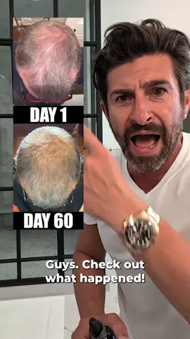 Check out these results 😳 BOOST helps hair growth without taking medication or using chemicals! It’s an all natural formula that gets insane results.👇