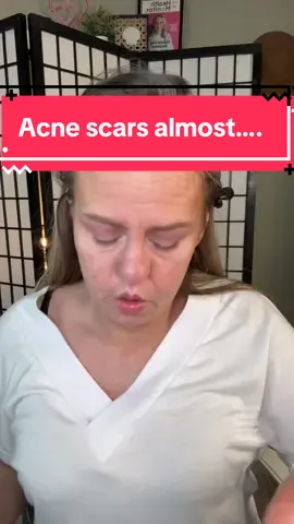Borderline embarrassing to post 🥲🥲 #acnescars #insecure #advice #womenover40 #creatorsearchinsights 