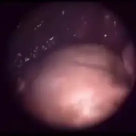 La fetoscopia endoscópica es un procedimiento quirúrgico mínimamente invasivo que utiliza un pequeño endoscopio para visualizar, diagnosticar y tratar anomalías en un feto dentro del útero. Se puede usar para realizar procedimientos terapéuticos, como la oclusión de vasos sanguíneos o la corrección de defectos fetales, entre otros.