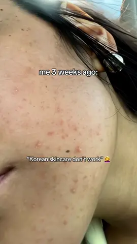 def get it now while it’s on sale usually it’s $62 😭 use code CREATORPIC for extra savings 💖#GlowUp #glassskin #tiktokshopcreatorpicks #tiktokshoplabordaysale #acne 