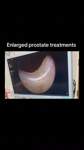 Enlarged prostate treatments; TURP versus Urolift #prostateproblems #urolift #turp #enlargedprostate #bph 