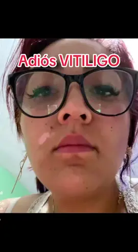 resultados de vitíligo gracias a los adaptogenos y Nanotecnología de Vitalhealt 