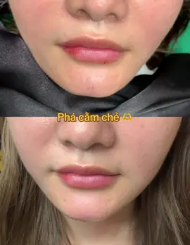 Phá cằm chẻ #trending #tiktokviral #foryou #xuhuong #fypシ 