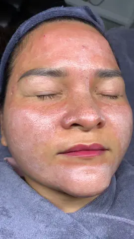 Khách bảo peel đau nhưng bong xong nó xứng đáng😁