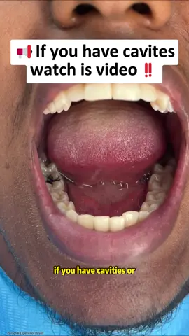 If you have cavities,watch is video#fyp #ceelike #whitening #toothpaste #SolidToothpasteReview #YellowTeethSolution #WhiteningTest #tooth #nanohydroxyapatite #OralCareTips #oralhealth #cavity 