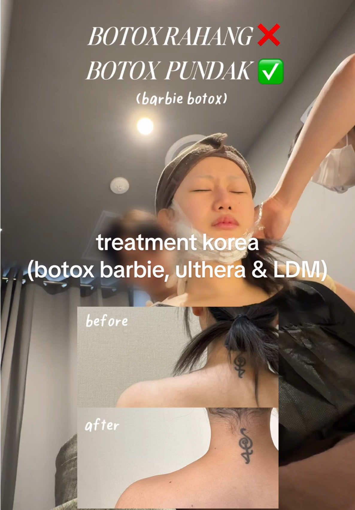 “BARBIE BOTOX” changed my life 😭🩷 Would recommend 10000%!!!  Treatments done: 🩷 TRAPEZIUS BOTOX (barbie botox): Botox injection into large trapezius muscles in the neck & shoulders to relax overactive muscles. Can improve postures and create a slimmer, more elongated neck appearance.  🩷 ULTHERA (100 shots for double chin area): Micro-focused ultrasound energy to stimulate new collagen production, leading to natural skin lifting & tightening. The most popular laser therapy for lifting! 🩷 LDM (Local Dynamic Micro-Massage): Dual-frequency ultrasound technology to promote skin regeneration, collagen production & increase hydration. Also great for acne treatments! All treatments done at @daybeau_ina in Gangnam, Seoul, with reasonable prices 🫰🏻 MUCH LOVEEE