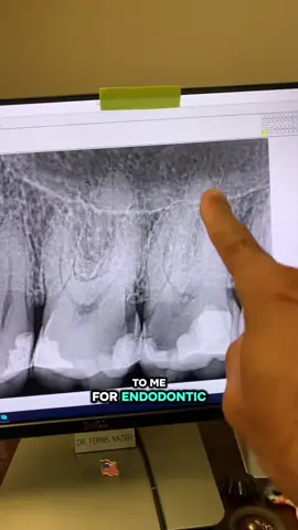 Large decay into the pulp. #dentists #rootcanal #dentistry #dentalstudent #dentalhygienist 