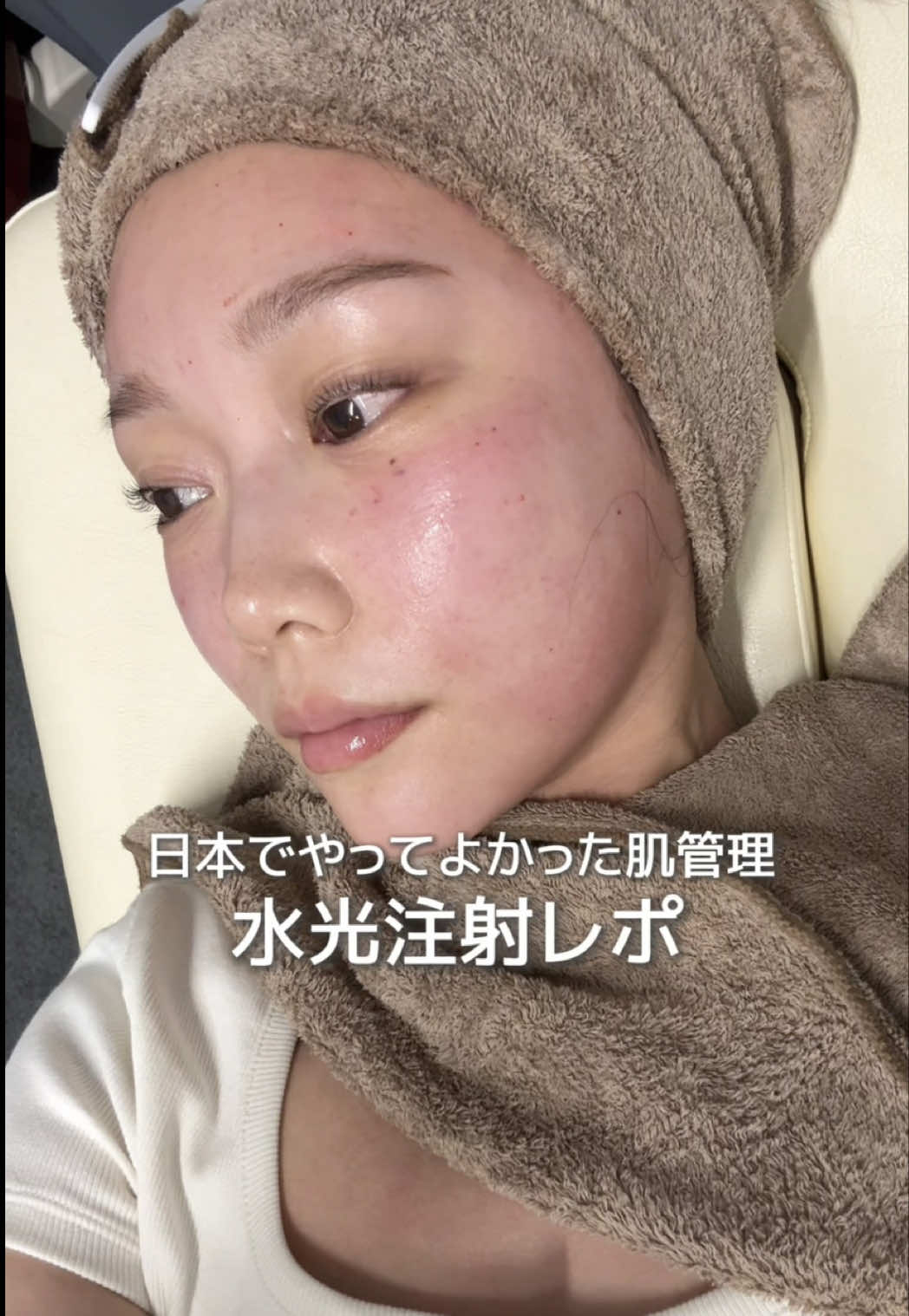 日本で過ごす肌管理レポ💆🏼‍♀️📝 月1くらいで肌管理は受けたいから 日本にいる時は @カンナムオンニ公式 を利用する事が多いよ✨ やりたい施術を決めて口コミなどを見ながら いつもカンナムオンニでクーポンを探しています👀 リアルな口コミが写真付きで豊富なので クリニック選びの参考になってる☺️ この日は水光注射を受けてきました💉 ヒアルロン酸を注入してお肌もプリプリに生き返った🥹 ダウンタイムも少なめで比較的受けやすいので日本では受ける事も多いよ🎶 しかもカンナムオンニで溜まってたポイントで かなりお得に肌管理できました🤤🤍 今なら初回3500円割引になって、 日本での施術はいつでも10%ポイントバック！ 口コミ投稿で最大15000Pゲットできちゃう✨✨ あっとゆーまにポイントがどんどん貯まるよ💰 定期的に美容医療を受ける人やこれから施術受けたいって人は カンナムオンニを使わないと勿体ない🤔‼︎ ぜひダウンロードしてみてください🧡✨ #PR #カンナムオンニ #美容クリニック #美容医療 #肌管理  