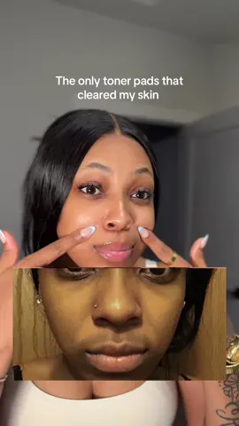 Bye bye insecurities heloooo clear skin 🥹🤍