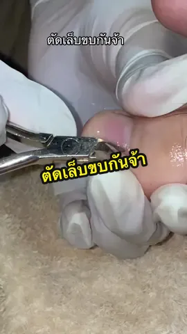ตัดเล็บขบอีกแล้วจ้า#ร้านทำเล็บพิษณุโลกALLYE #ตัดเล็บขบพิษณุโลก #cutingrowntoenail #ตัดเล็บขบ #เล็บขบ 