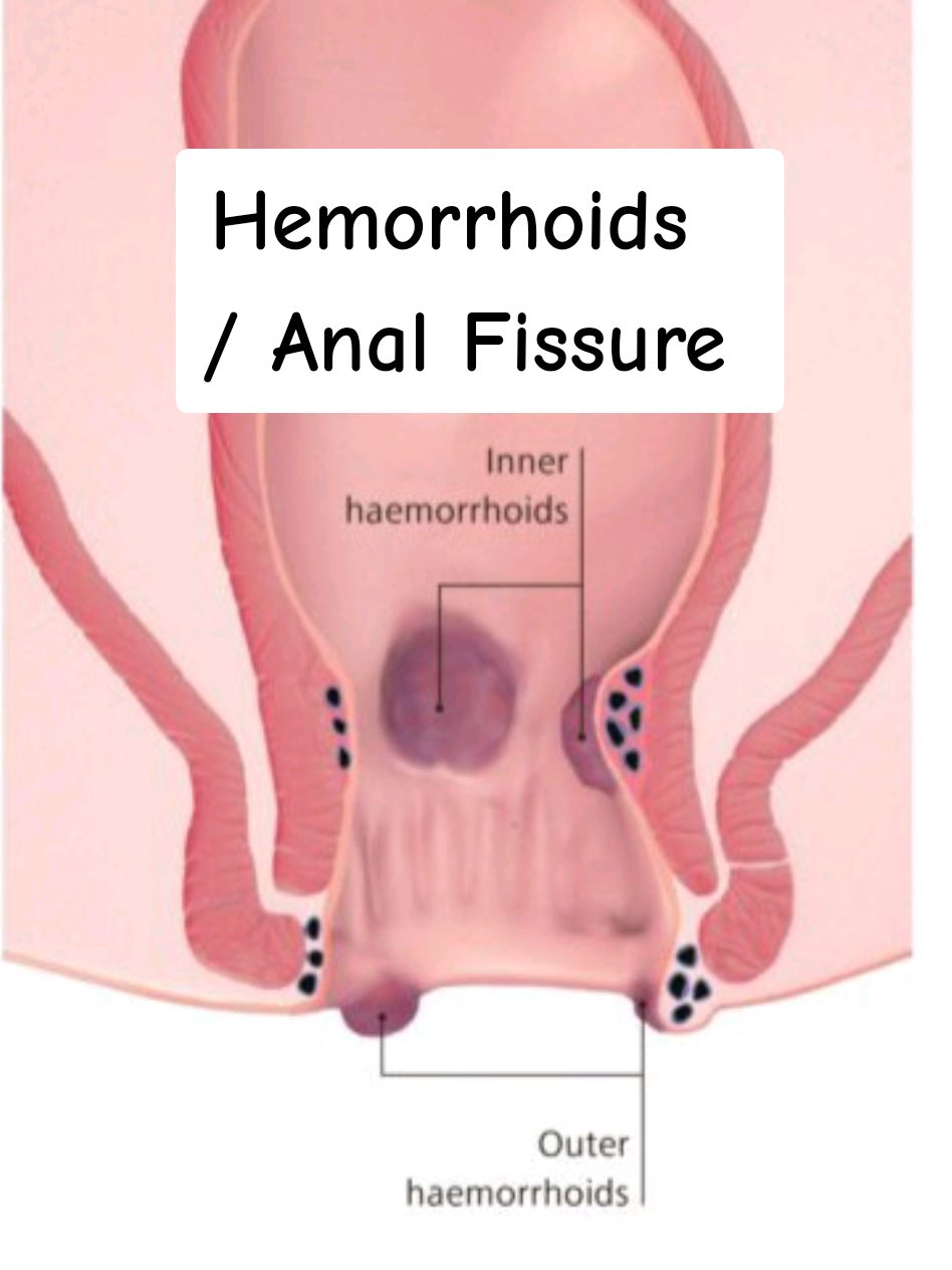 Replying to @jamalfarrukh0 Hemorrhoids and  Anal Fissure |  This Vedio is only for Information Consult your doctor before use |  please tiktok  don't Underwear my Vedio   and  Viral this  to Which searches according to hemorrhoids , Anal Fissure  and  piles  |  please Viral This Vedio  |  #hemorrhoids  #foryoupage #Fyp #Viral #trending 