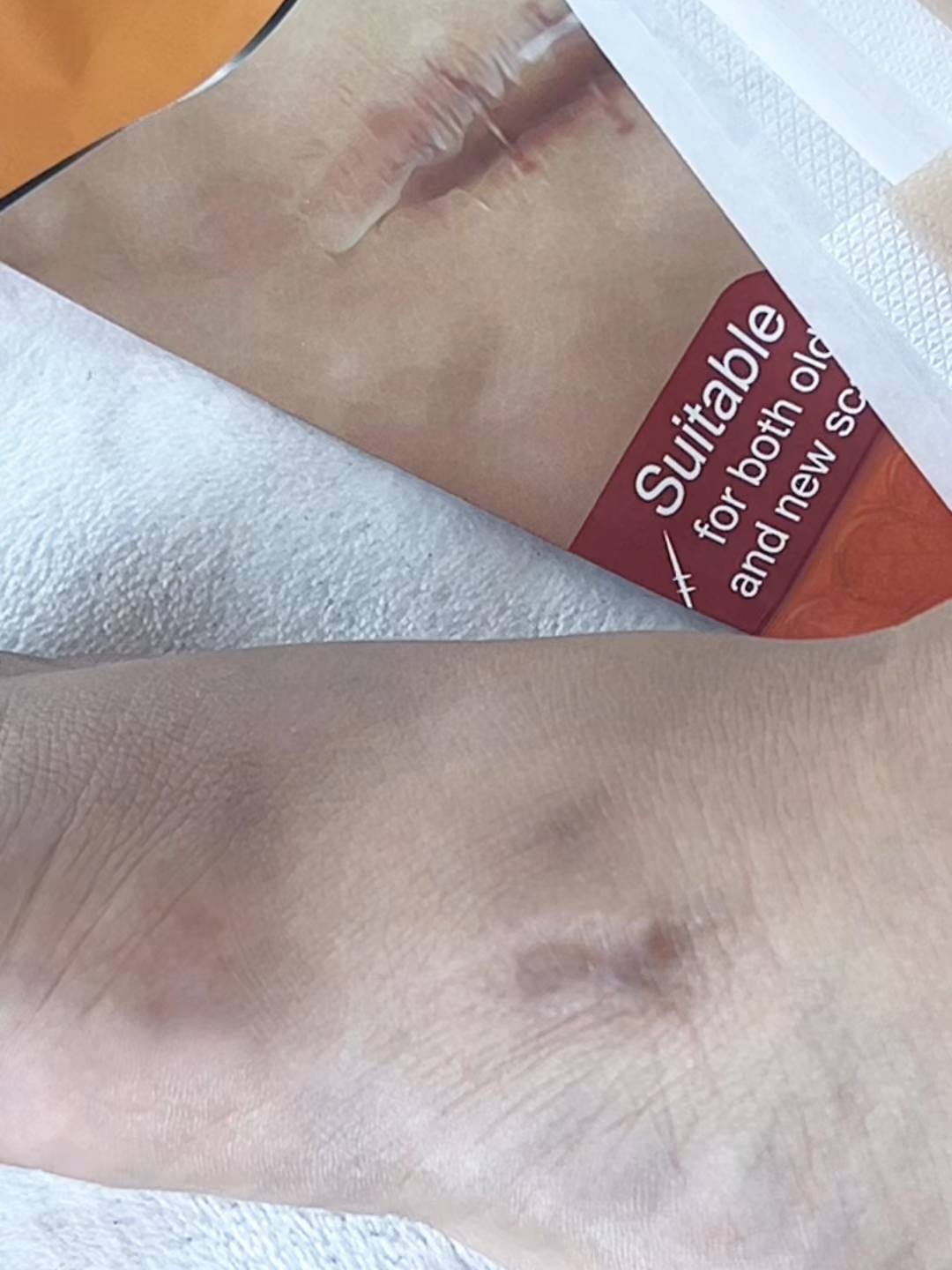 💖 From scar to smooth 💖 Trust Be Better Silicone Gel Sheet to support your healing journey ✨ #BeBetterSkin #ScarCare #GlowUp #SkincareThatWorks #TikTokMadeMeTryIt #scar #keloid #pigmentation #healingjourney #woundcare