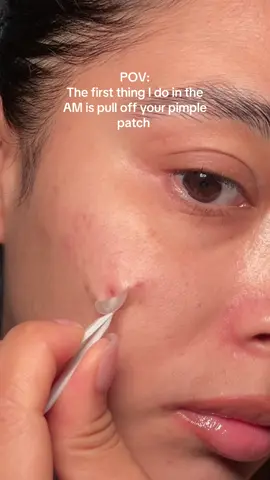 Best feeling TBH🥰 #pumplepatch #pimplepatchremoval #pimplepatchpeel #pimplepatches 