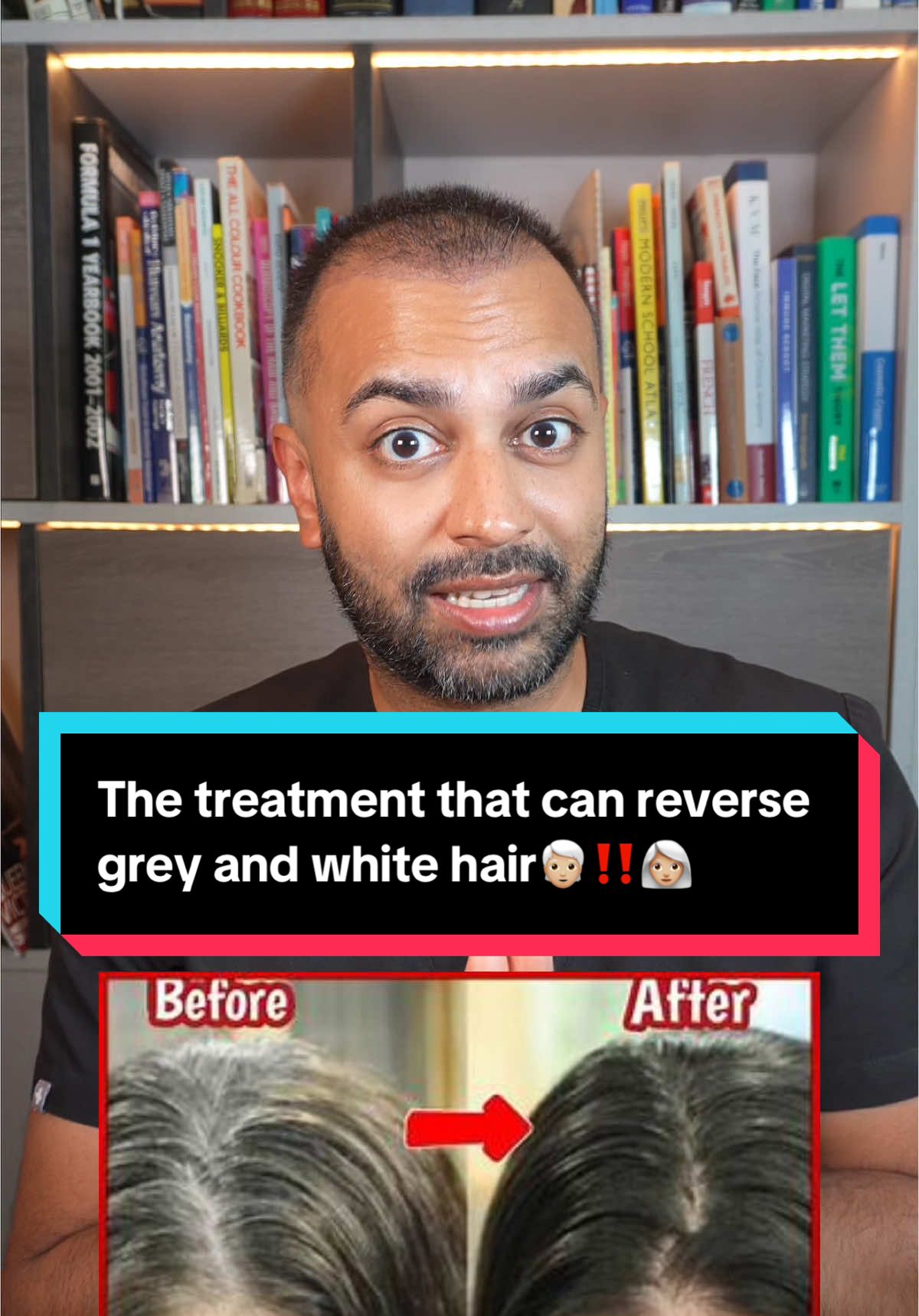 Have you heard about the new treatment to reverse grey and white hairs⁉️ let’s discuss it… #HairCareTips #greyhair #treatment #microneedling #microneedlingtherapy 