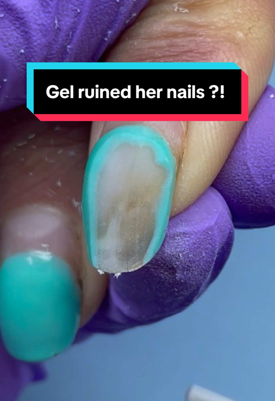 Please don’t cover nails like these with the product ! #nailinspo #nails #nailhealth #naildamage #nail #nailtech 