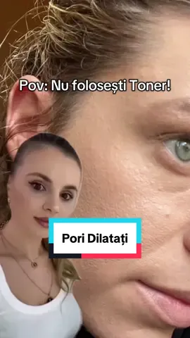 Un toner poate fi util în rutina de îngrijire a tenului cu pori dilatați, pentru că: 	•	Curăță delicat resturile de machiaj, impurități sau urme de demachiant. 	•	Reechilibrează pH-ul pielii după spălare. 	•	Controlează sebumul (în special formulele cu ingrediente precum acid salicilic sau niacinamidă). 	•	Exfoliază ușor (dacă include acizi AHA sau BHA), ajutând la deblocarea porilor și la diminuarea aspectului lor. 	•	Hidratează și pregătește pielea pentru cremele sau serurile aplicate ulterior. 👉 Pentru tenul cu pori dilatați, se recomandă un toner cu: 	•	Acid salicilic (BHA) – curăță porii în profunzime. 	•	Niacinamidă – reduce producția de sebum și uniformizează textura pielii. 	•	Acid glicolic/lactic (AHA) – exfoliere blândă pentru o suprafață mai netedă. 	•	Extracte calmante (hamamelis, ceai verde, aloe vera) – reduc inflamația și roșeața.  #drralucaharnagea #pores #skincare #toner #foru  