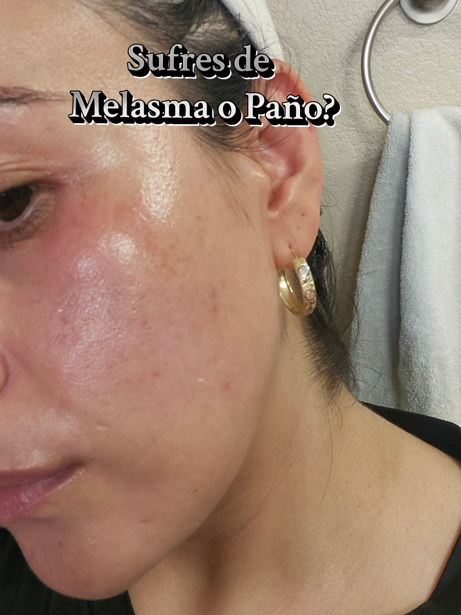 Esteticista en Denver Colorado  #melasma #piel #paño #facial #denver 