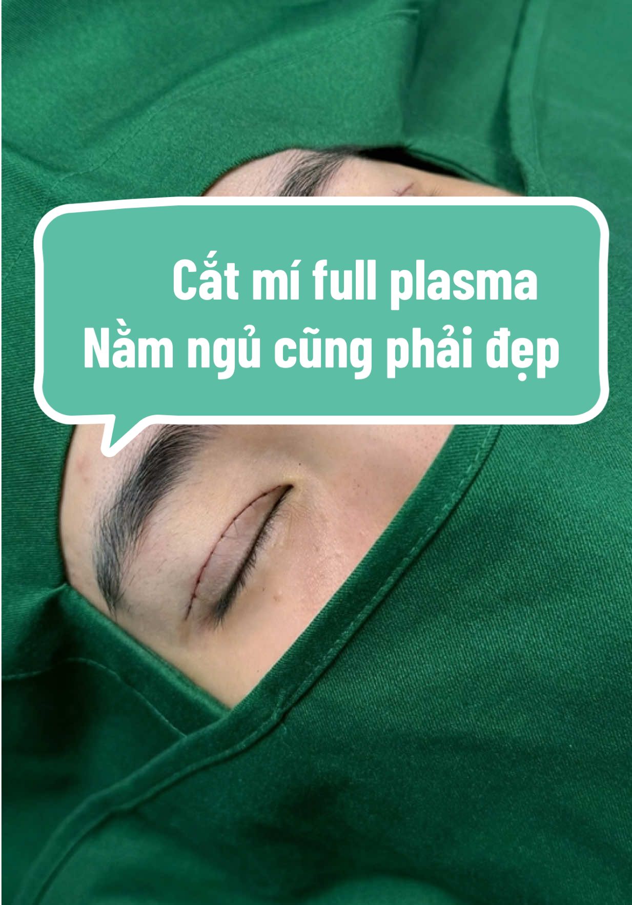 Đường cắt mí nhà Thúy Lê, chuẩn mướt Mường mượt .#catmidep #lamdepuytin #catmitunhien #CapCut 