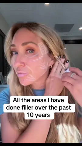 I have about 7 syringes of dermal filler in my face currently. I started getting filler in my mid 30s and have no regrets! When dermal filler is done with skill the results can look amazing and natural. #filler #over40 #agegracefully #antiagingskincare #fillermigration 