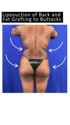 ✨ Sculpt + Shape ✨ This transformation shows the power of combining liposuction with fat grafting. Excess fat was removed from the back, then carefully transferred to enhance the buttocks—creating smoother lines, balanced curves, and a naturally contoured silhouette. 🍑 #Liposuction #BBL #FatTransfer #BodyContours #NaturalCurves #ConfidenceGoals #AkronPlasticSurgery #DrCarp