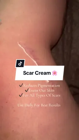 Cannot believe how quickly the pigmentation from my scar is easing with this cream ☺️ #scar #scarcream #tiktokmademebuyit 