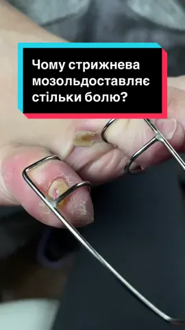 ЧИ ВІДЧУВАЛИ ВИ ЦЮ БІЛЬ? Наче струмом бʼє кожен раз, коли наступаєш на ногу? Це стрижнева мозоль — маленька, але дуже підступна. Вона росте всередину, тисне на нервові закінчення і викликає різкий біль навіть при легкому русі. Правильне видалення — без болю і травм для шкіри.  #подологія #стрижневамозоль #здоровістопи #безболю #подологмиколаїв 
