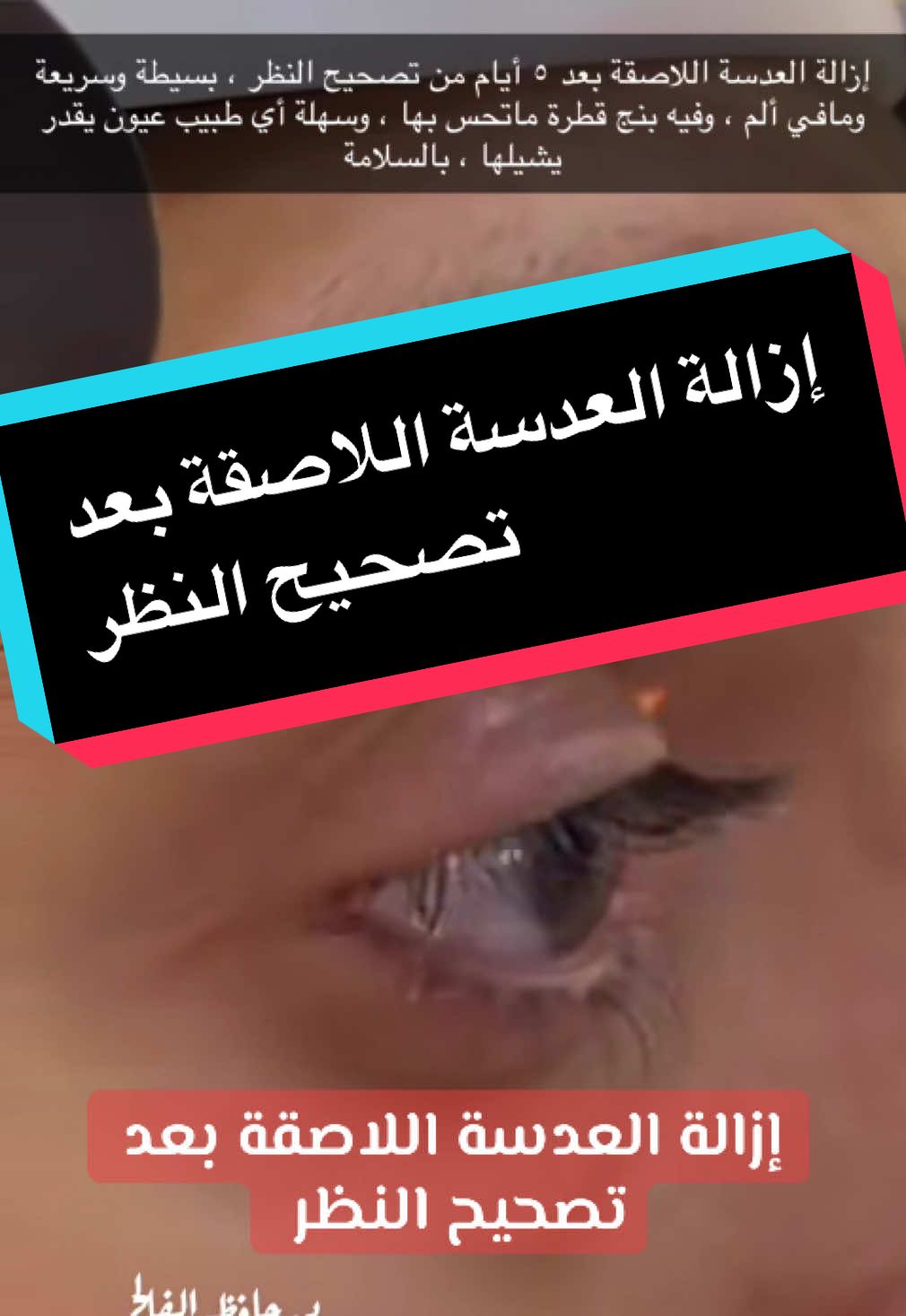 إزالة العدسات اللاصقة بعد #تصحيح_النظر  #اكسبلورexplore 
