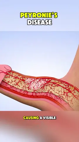 Peyronis disease  #surgery #peyronie #peyroniesdisease #peyronies #peyroniedisease #peyroniesawareness #peyronieswarrior #peyronies #shockwaves #shockwavesmousse #shockwavestarscream 
