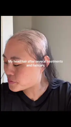 It’s not fair #balding #hair #fyp #trending #comedy 