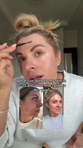 Tell me your favorite treatments or products in comments! Love learning more about skincare and investing in it as I age #skincare #medicalgradeskincare #ezgel #microneedling #momtok 